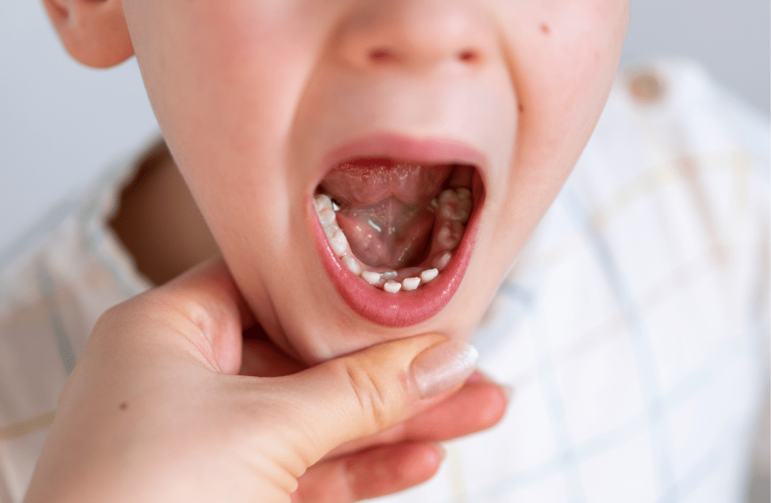 歯並びが悪い子ども