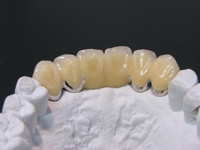 メタルボンド②